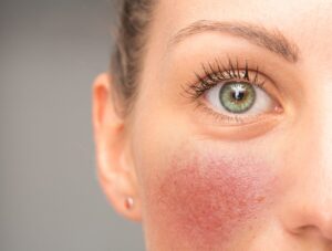 Person med rosacea får behandling hos Klinikk Skien